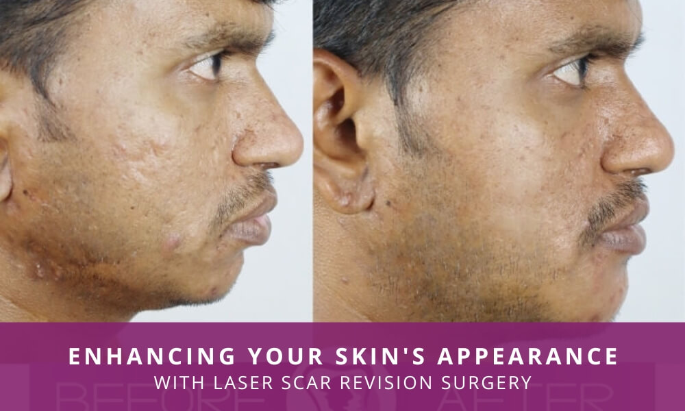 Laser Technology